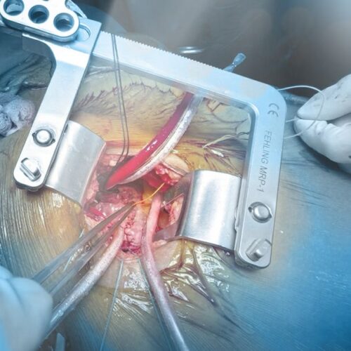 MICS Heart Surgery
