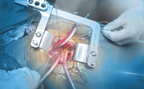 MICS Heart Surgery