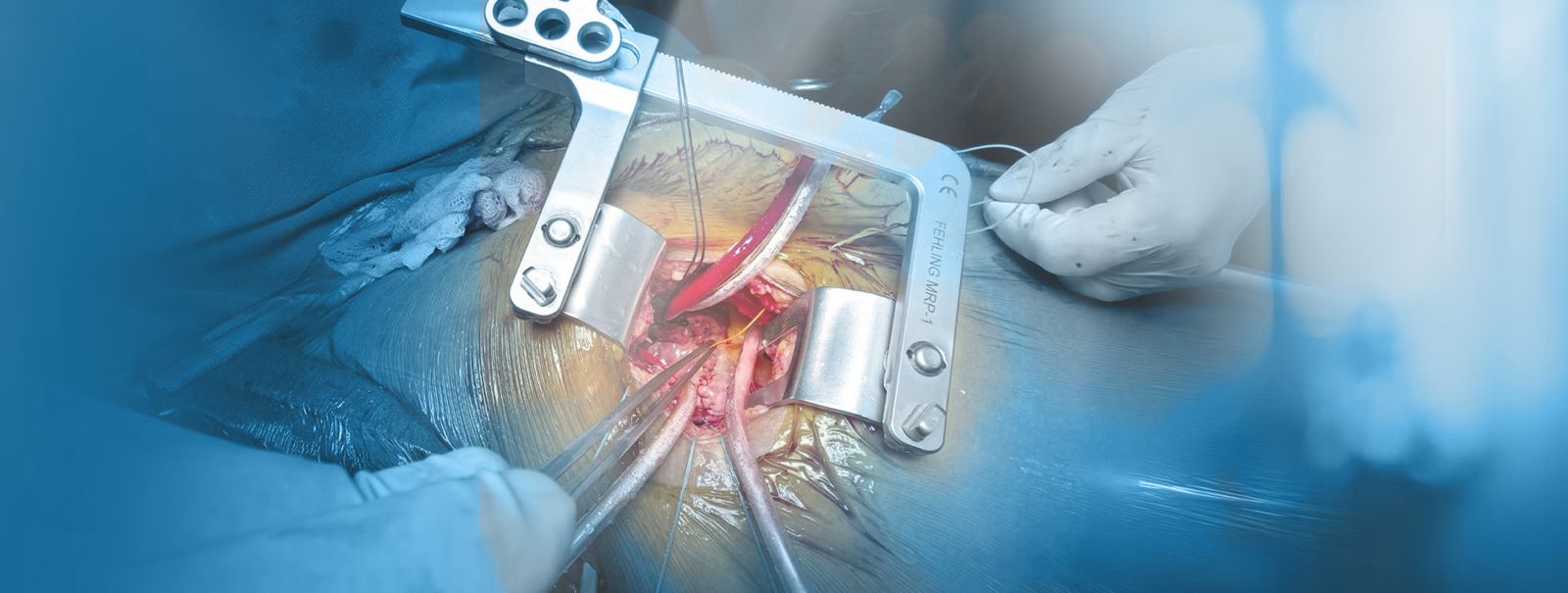 Minimally Invasive Cardiac Surgery